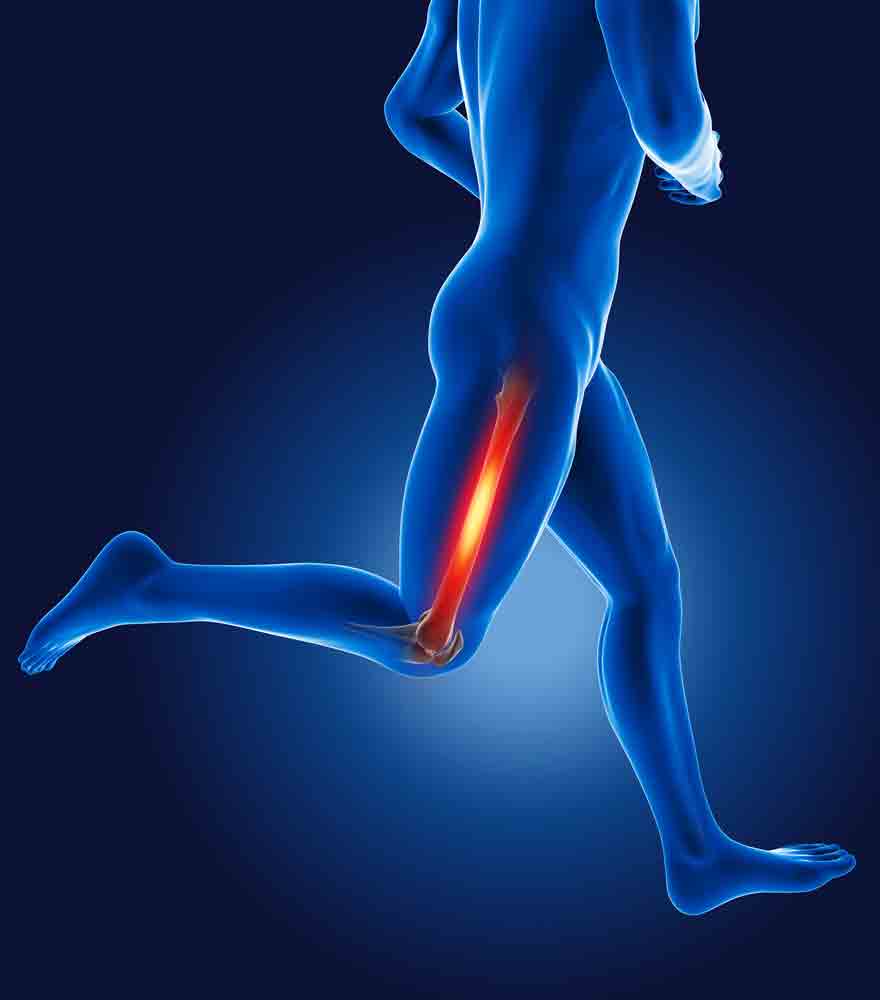 Managing IT Band Friction Syndrome running leg pain physical therapy oakland 128648288 1 Managing IT Band Friction Syndrome