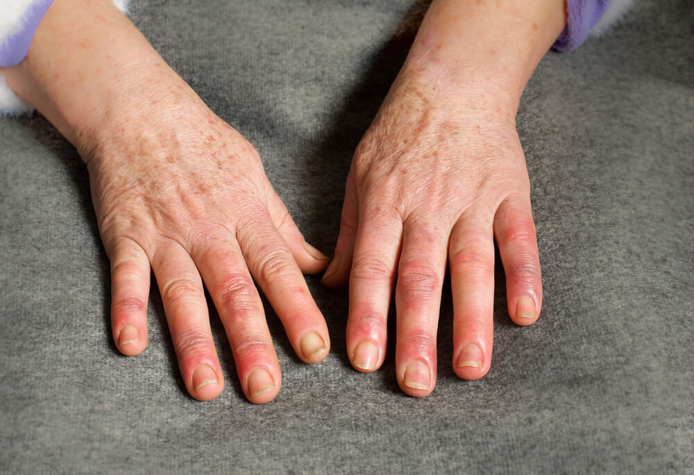 Why are my fingers swollen and sore?