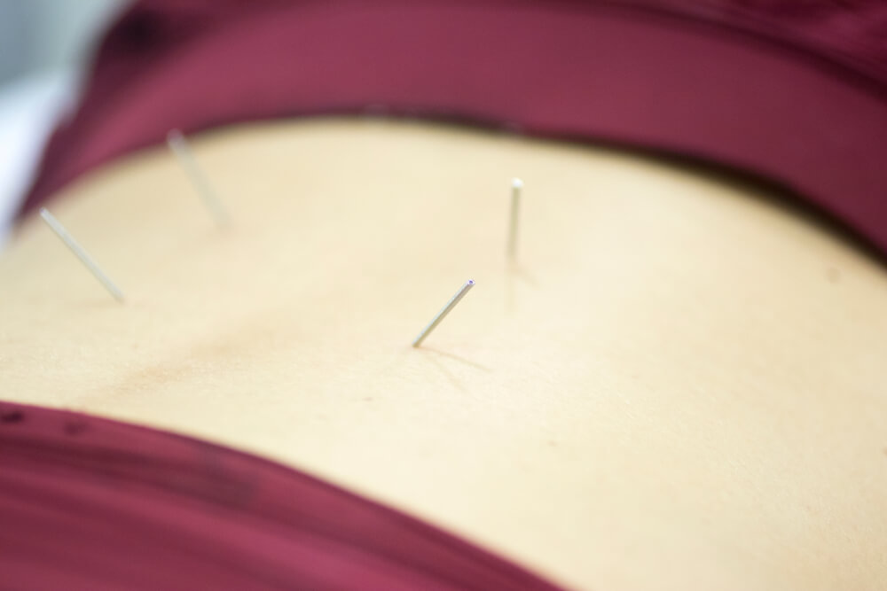 Why is my physical therapist talking about using dry needling for my sciatica? shutterstock 1252713871 Why is my physical therapist talking about using dry needling for my sciatica?