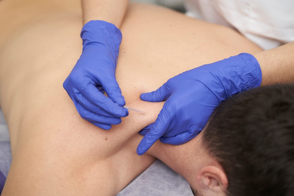 What are some benefits of trying dry needling near me? shutterstock 2141181079 What are some benefits of trying dry needling near me?