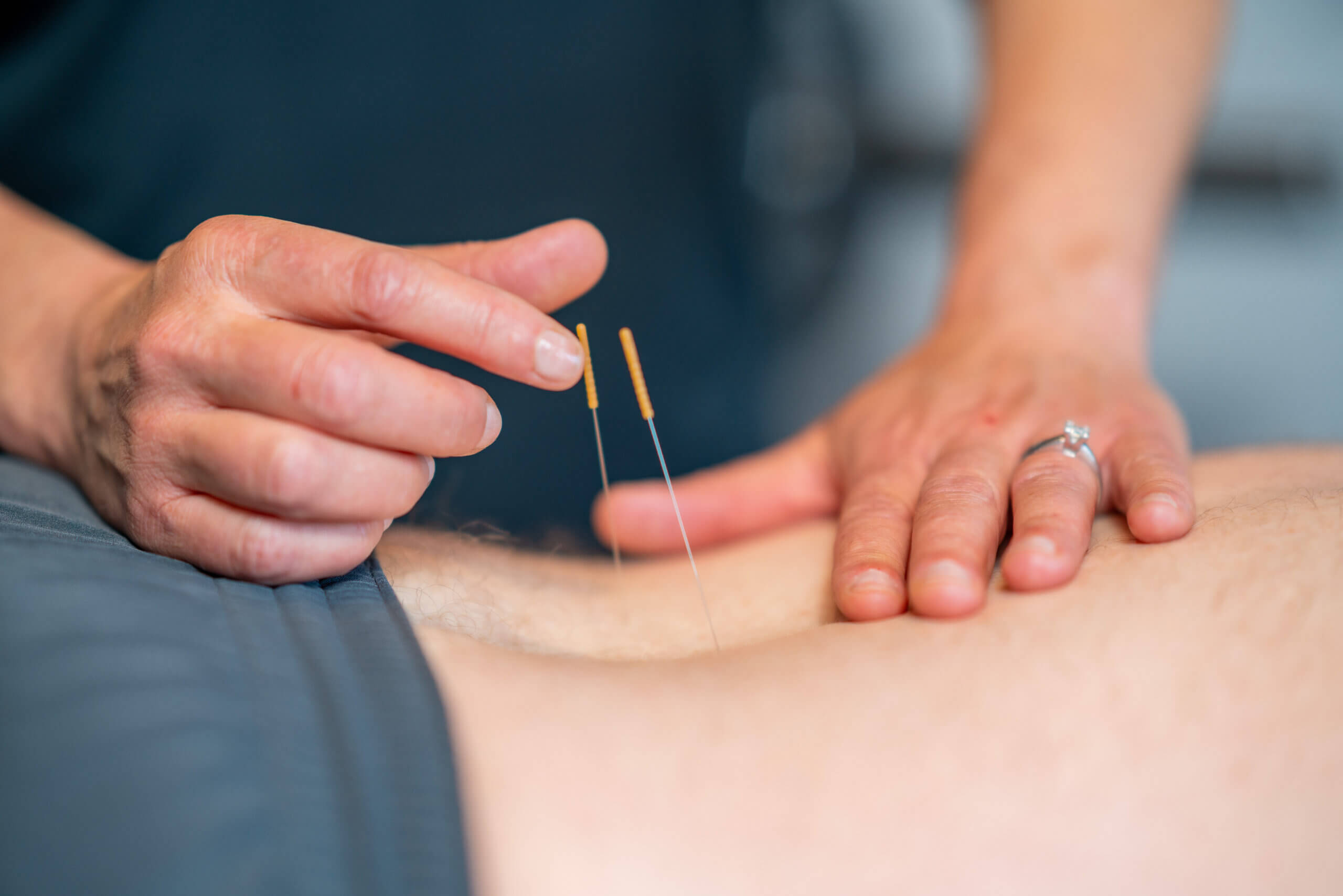 Dry Needling in Apache Junction, AZ AdobeStock 457665050 scaled 1 Dry Needling in Apache Junction, AZ